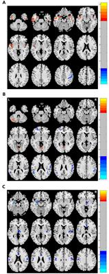 Reduced suicidality after electroconvulsive therapy is linked to increased frontal brain activity in depressed patients: a resting-state fMRI study